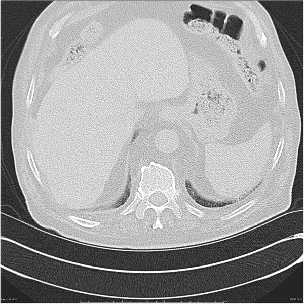 File:Cavitating left lower lobe lesion - squamous cell lung cancer (Radiopaedia 27749-28176 Axial lung window 45).jpg