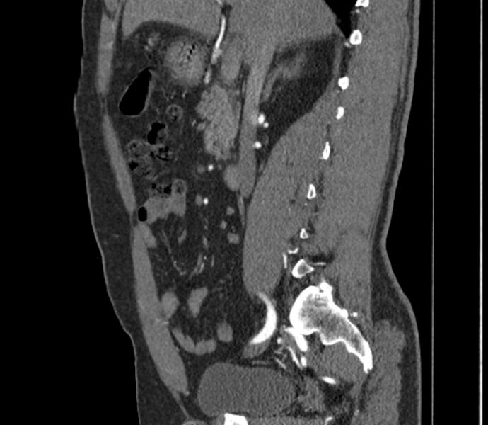 File:Celiac artery dissection (Radiopaedia 52194-58080 B 13).jpg