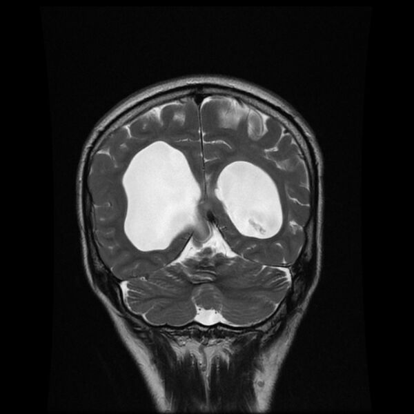 File:Central neurocytoma (Radiopaedia 67618-77021 Coronal T2 17).jpg