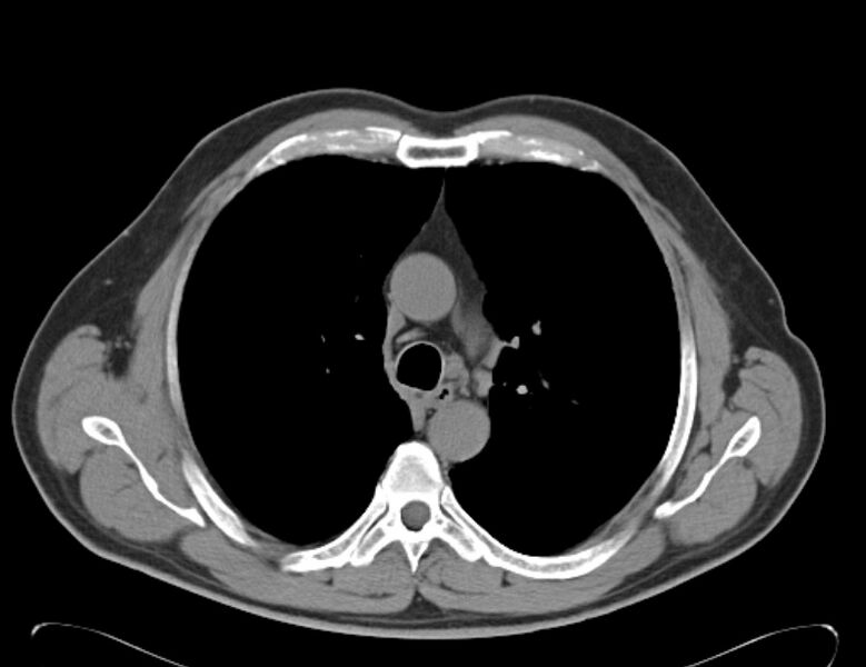 File:Centrilobular pulmonary emphysema (Radiopaedia 26808-26971 Axial non-contrast 16).jpg