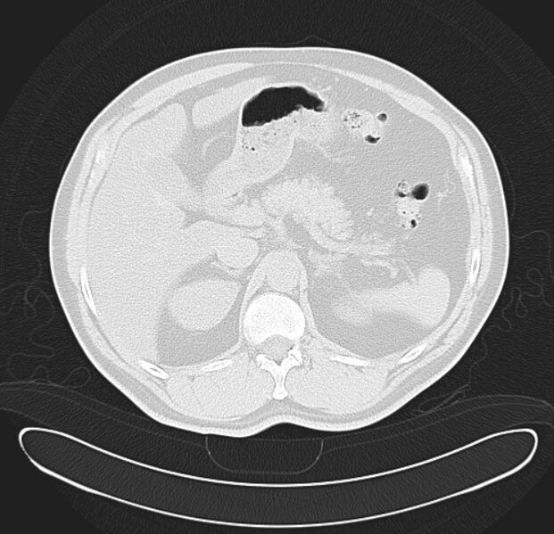 File:Centrilobular pulmonary emphysema (Radiopaedia 26808-26971 C 47).jpg
