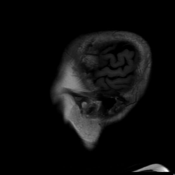 File:Cerebellar ataxia with neuropathy and vestibular areflexia syndrome (CANVAS) (Radiopaedia 74283-85159 Sagittal FLAIR 20).jpg
