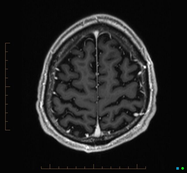 File:Cerebellar gangliocytoma (Radiopaedia 65377-74422 Axial T1 C+ 121).jpg