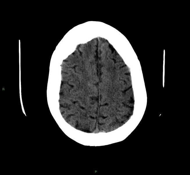 File:Cerebellar hemorrhage (Radiopaedia 58792-66026 Axial non-contrast 12).jpg