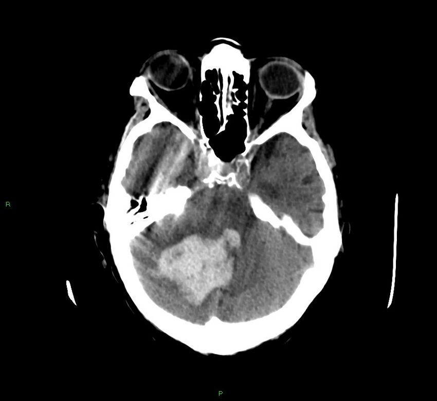 Cerebellar hemorrhage (Radiopaedia 58792-66026 Axial non-contrast 36).jpg