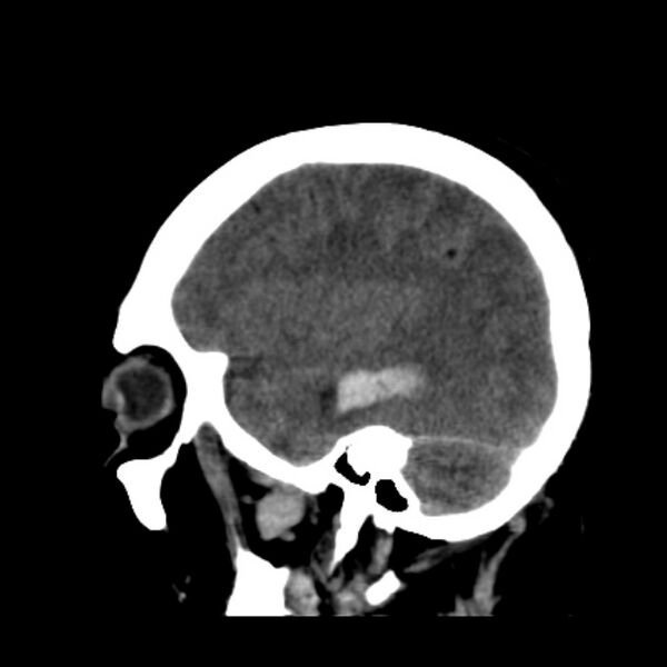 File:Cerebellar hemorrhage causing obstructive hydrocephalus (Radiopaedia 33989-35207 B 13).jpg