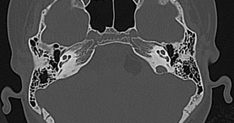 File:Cerebellopontine angle lipoma (Radiopaedia 57303-64242 Axial bone window 25).jpg