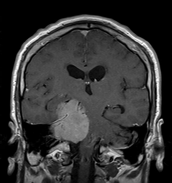 File:Cerebellopontine angle meningioma (Radiopaedia 24459-24764 Coronal T1 C+ 13).jpg