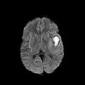 Cerebral abscess post cardiac surgery (Radiopaedia 27244-27420 Axial DWI 10).jpg