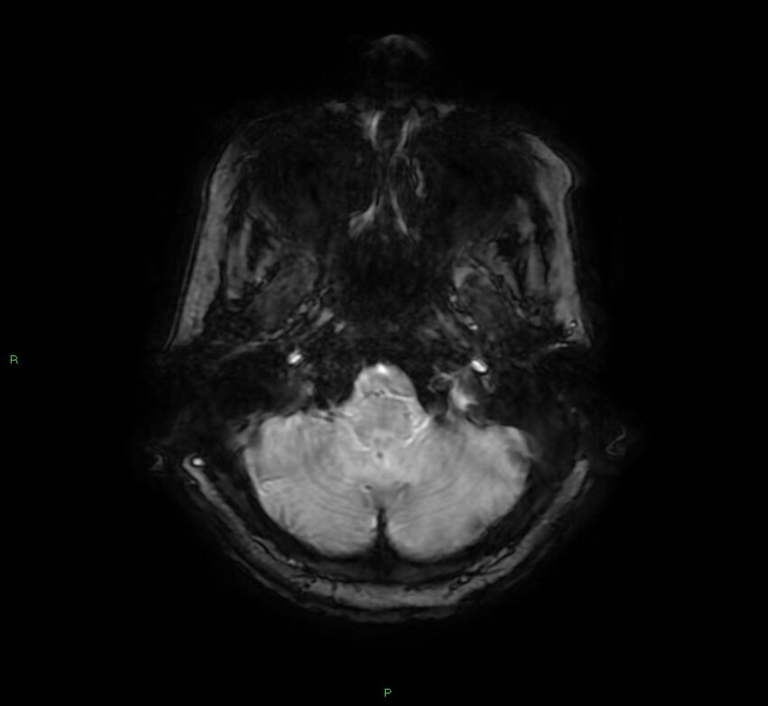 Cerebral amyloid angiopathy-associated lobar intracerebral hemorrhage (Radiopaedia 58378-65517 Axial SWI 11).jpg
