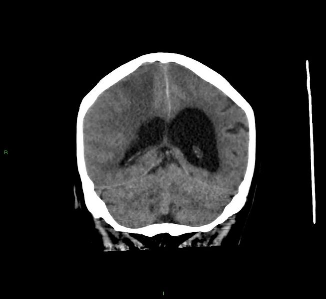 File:Cerebral amyloid angiopathy-associated lobar intracerebral hemorrhage (Radiopaedia 58560-65723 Coronal non-contrast 25).jpg
