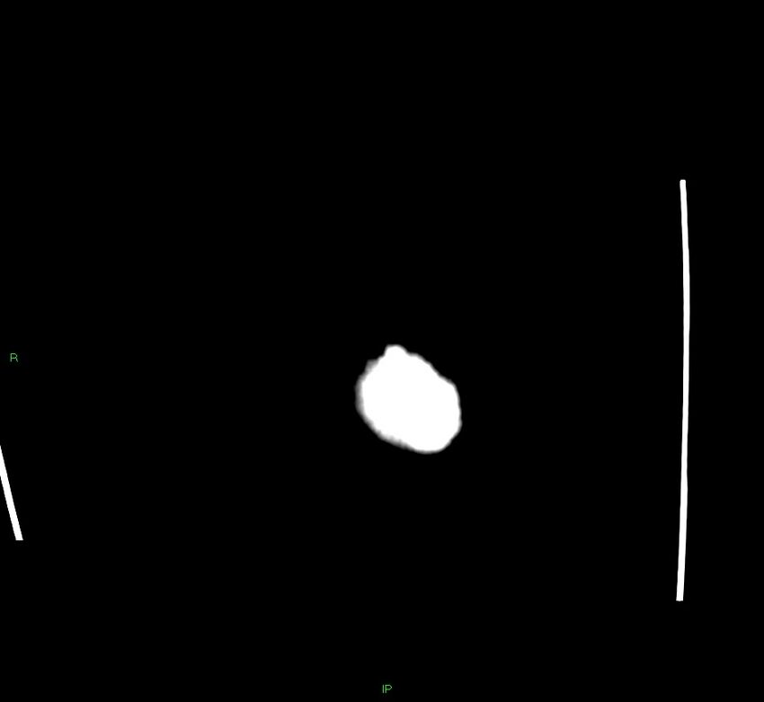 Cerebral amyloid angiopathy-associated lobar intracerebral hemorrhage (Radiopaedia 58563-65727 Coronal non-contrast 3).jpg