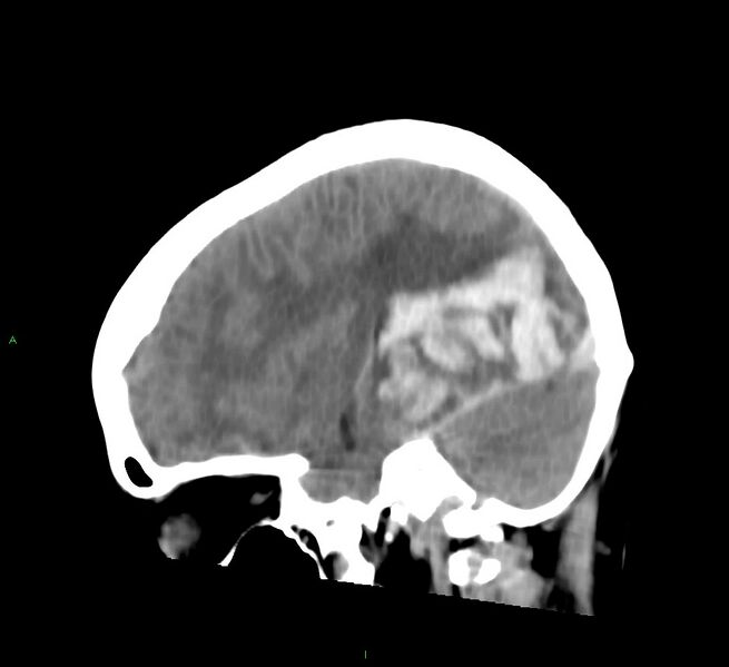File:Cerebral amyloid angiopathy-associated lobar intracerebral hemorrhage (Radiopaedia 58754-65975 C 33).jpg