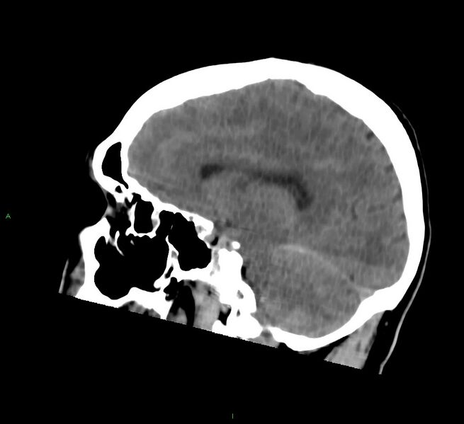 File:Cerebral amyloid angiopathy-associated lobar intracerebral hemorrhage (Radiopaedia 58756-65977 C 35).jpg