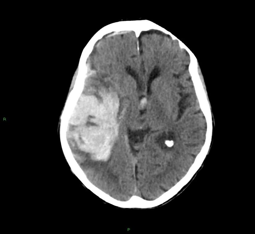 Cerebral amyloid angiopathy-associated lobar intracerebral hemorrhage (Radiopaedia 58758-65980 Axial non-contrast 27).jpg