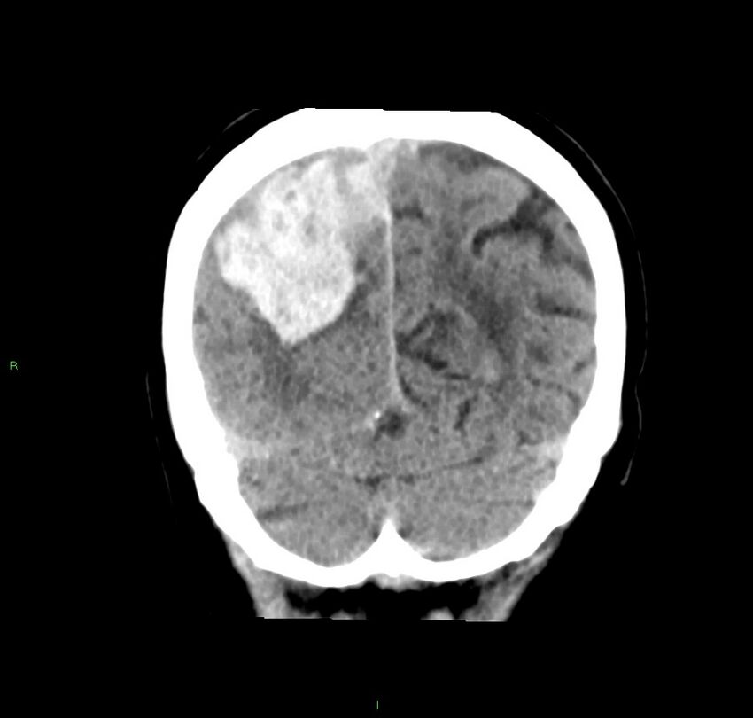 Cerebral amyloid angiopathy-associated lobar intracerebral hemorrhage (Radiopaedia 59356-66716 Coronal non-contrast 17).jpg