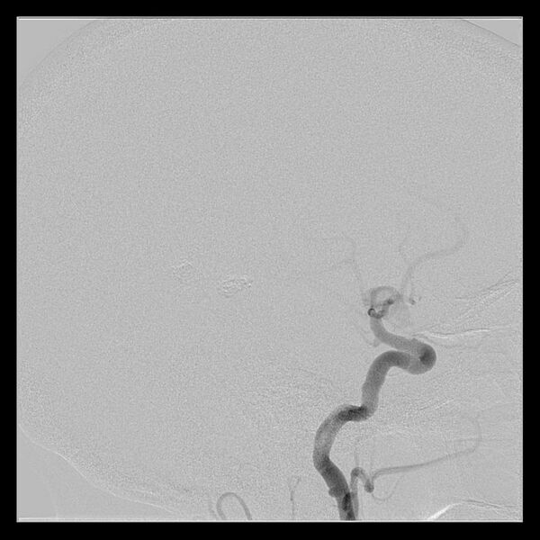 File:Cerebral aneurysm with rupture (Radiopaedia 29933-30458 LT CCA IC 38).jpg