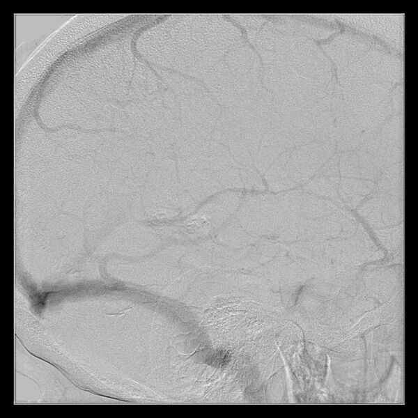 File:Cerebral aneurysm with rupture (Radiopaedia 29933-30458 LT ICA IC 50).jpg