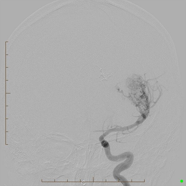 File:Cerebral arteriovenous malformation (AVM) (Radiopaedia 78162-90707 C 6).jpg