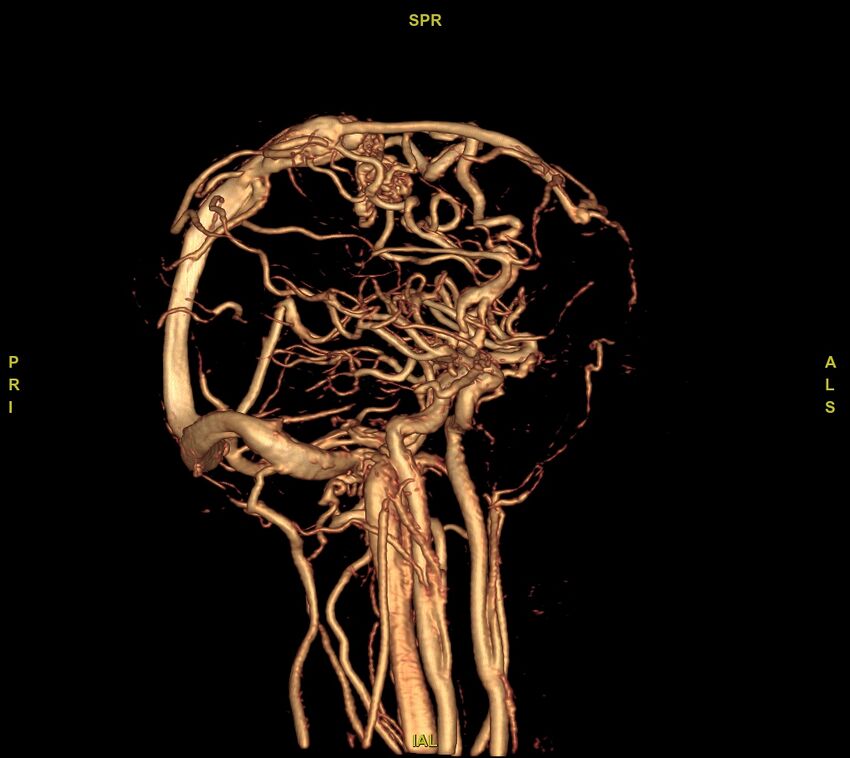Cerebral arteriovenous malformation (Radiopaedia 61964-70029 VRT 31).jpg