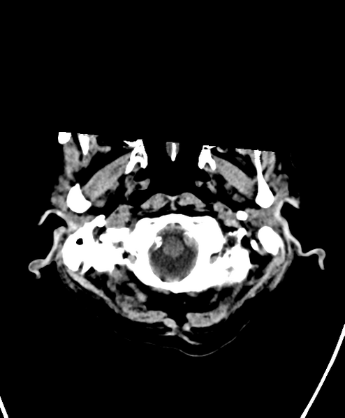File:Cerebral contusions, subarachnoid hemorrhage and subdural hygromas (Radiopaedia 55399-61828 Axial non-contrast 2).png
