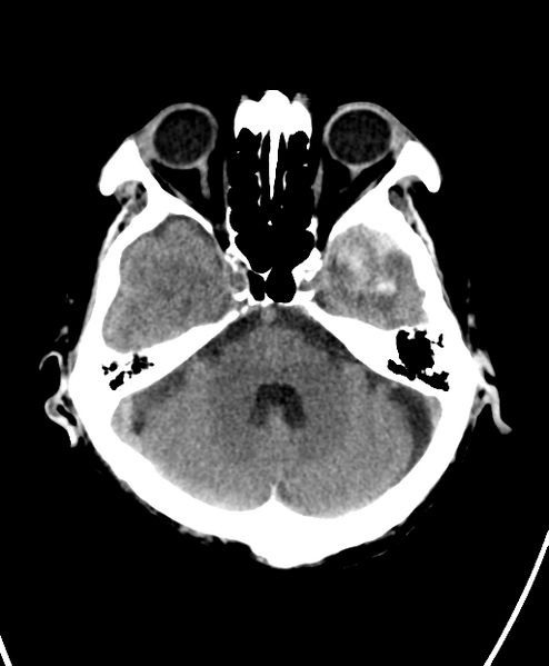 File:Cerebral contusions, subarachnoid hemorrhage and subdural hygromas (Radiopaedia 55399-61828 Axial non-contrast 8).png