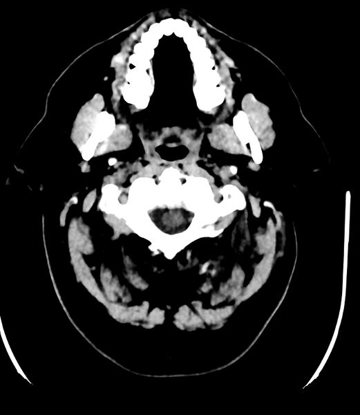 File:Cerebral dural venous sinus thrombosis (Radiopaedia 86514-102575 Axial non-contrast 2).jpg
