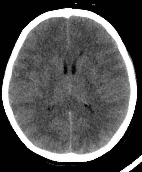 File:Cerebral edema due to severe hyponatremia (Radiopaedia 89826-106937 Axial non-contrast 51).jpg
