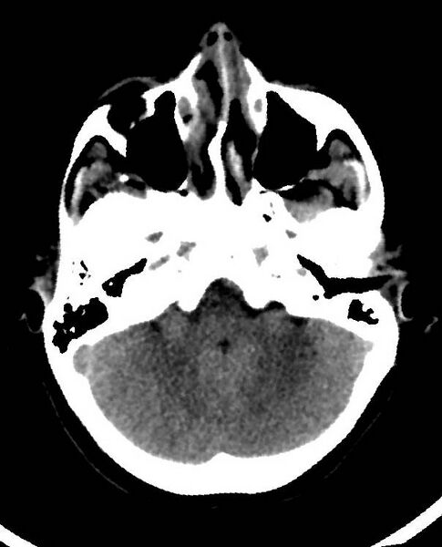 File:Cerebral edema due to severe hyponatremia (Radiopaedia 89826-106938 Axial non-contrast 25).jpg