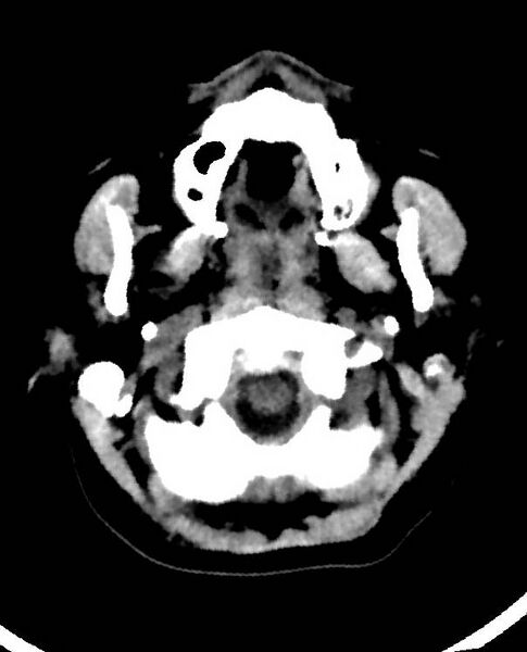 File:Cerebral edema due to severe hyponatremia (Radiopaedia 89826-106938 Axial non-contrast 9).jpg