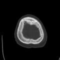 Cerebral hemorrhagic contusions (Radiopaedia 23145-23188 Axial bone window 53).jpg