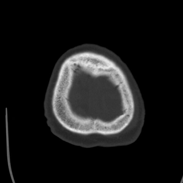 File:Cerebral hemorrhagic contusions (Radiopaedia 23145-23188 Axial bone window 53).jpg