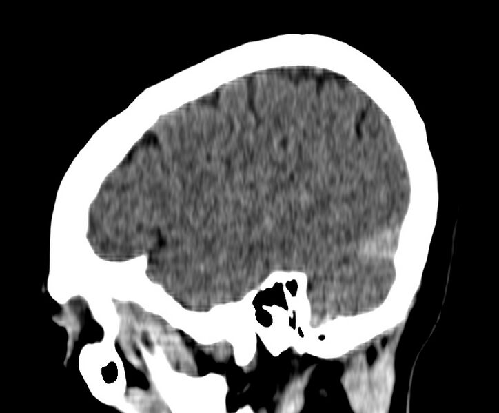 File:Cerebral venous thrombosis - CT only (Radiopaedia 41031-43778 B 37).jpg