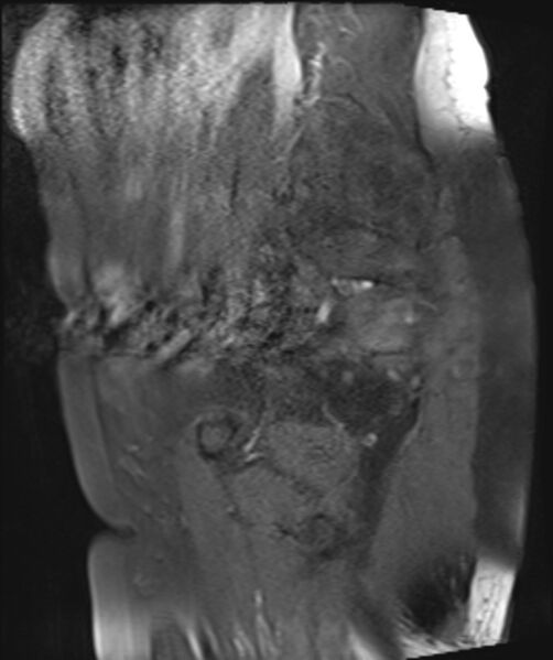 File:Cervical carcinoma (Radiopaedia 88312-104943 Sagittal T1 fat sat 8).jpg