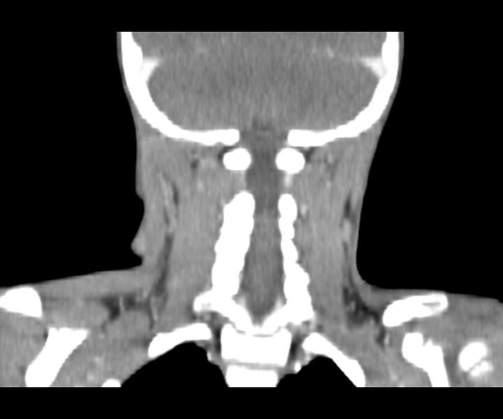 File:Cervical cystic lymphangioma (Radiopaedia 63655-72332 Coronal + contrast 27).jpg