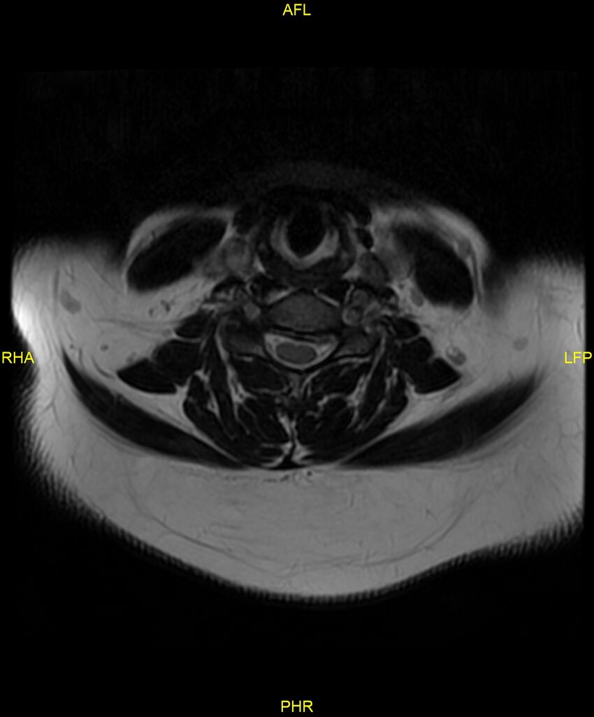 Cervical disc protrusion (Radiopaedia 87147-103415 Axial T2 30).jpg