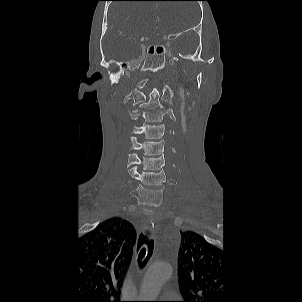 File:Cervical spine fractures with vertebral artery dissection (Radiopaedia 32135-33078 Coronal bone window 9).jpg