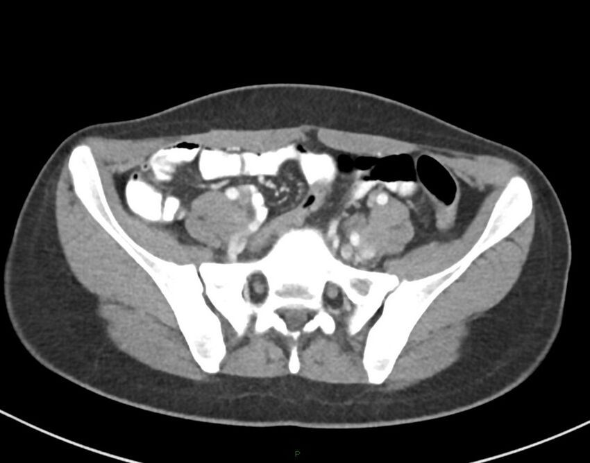 Cesarean scar endometriosis (Radiopaedia 82925-97262 A 62).jpg