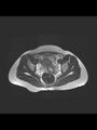 Cesarean section scar endometrioma (Radiopaedia 56569-63297 Axial T2 16).jpg