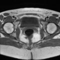 Cesarian section scar endometriosis (Radiopaedia 66520-75799 Axial T1 19).jpg