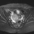 Cesarian section scar endometriosis (Radiopaedia 66520-75799 Axial T2 fat sat 9).jpg