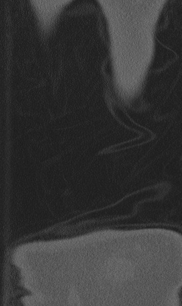 File:Chance fracture (Radiopaedia 40360-42912 Coronal bone window 78).png