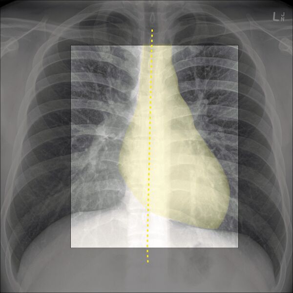File:Chest x-ray - circulation (Radiopaedia 32664-33633 B 1).jpg
