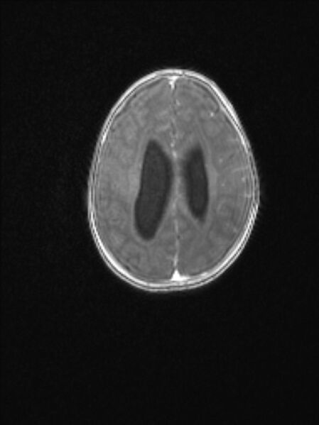 File:Chiari III malformation with occipital encephalocele (Radiopaedia 79446-92559 Axial T1 C+ mpr 63).jpg