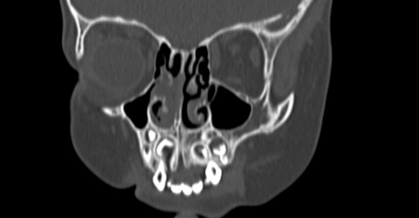 Choanal atresia (Radiopaedia 51295-56972 Coronal bone window 23).jpg