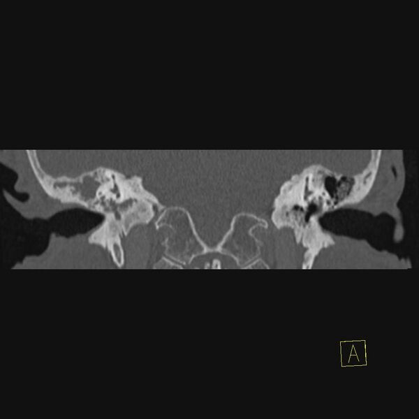 File:Cholesteatomatous chronic otitis (Radiopaedia 14993-14911 Coronal bone window 4).JPEG