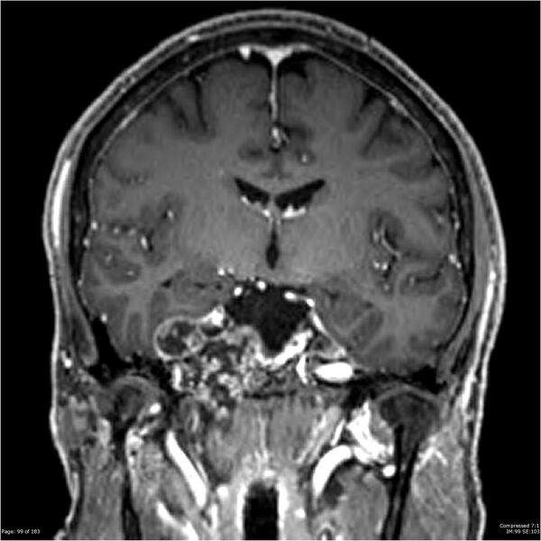 File:Chondrosarcoma of skull base- grade II (Radiopaedia 40948-43654 Coronal T1 C+ 10).jpg