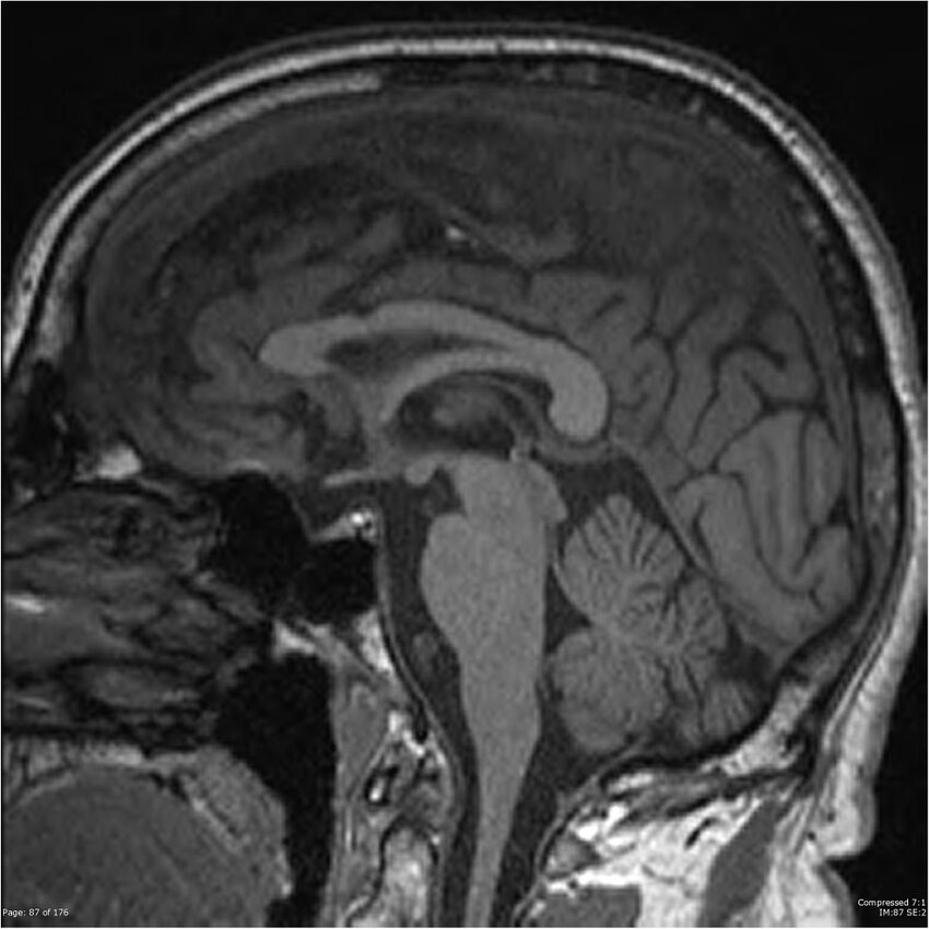 Chondrosarcoma of skull base- grade II (Radiopaedia 40948-43654 Sagittal T1 10).jpg