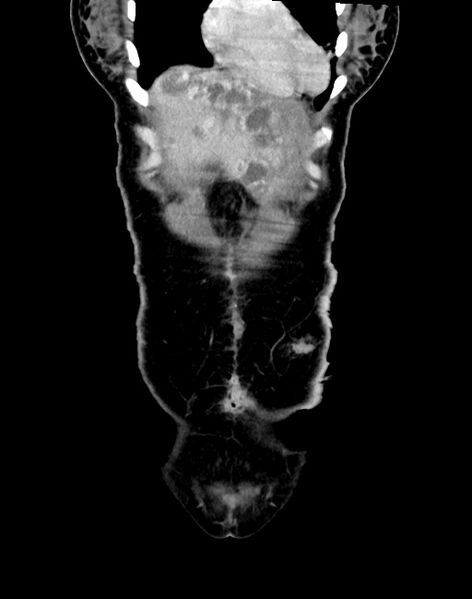 File:Choriocarcinoma liver metastases (Radiopaedia 74768-85766 B 22).jpg