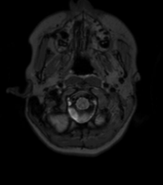 File:Choroid plexus carcinoma (Radiopaedia 91013-108553 Axial T2 fat sat 28).jpg